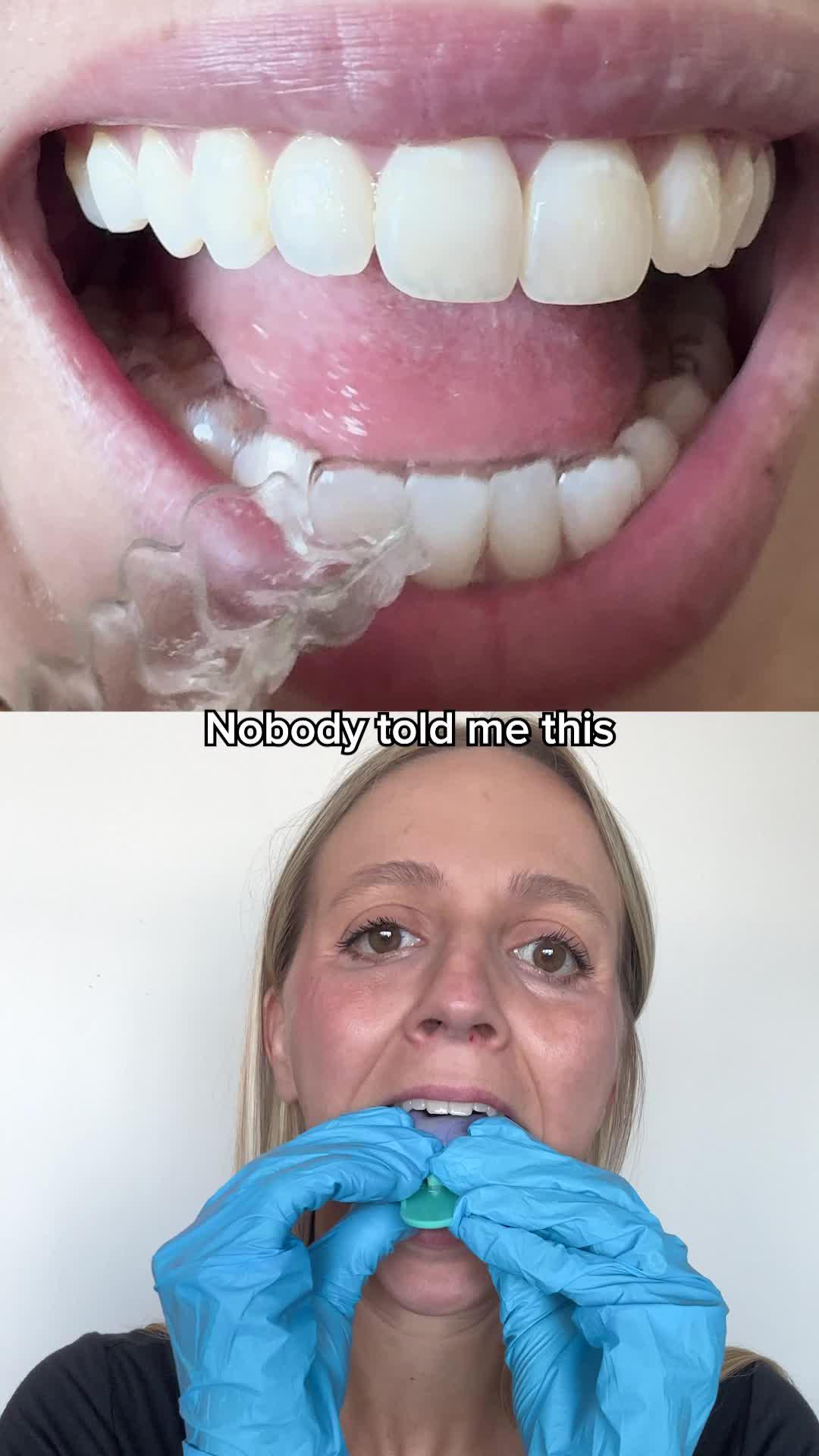 Braces can cost $5,000+. SmileSet aligners? Way less.
