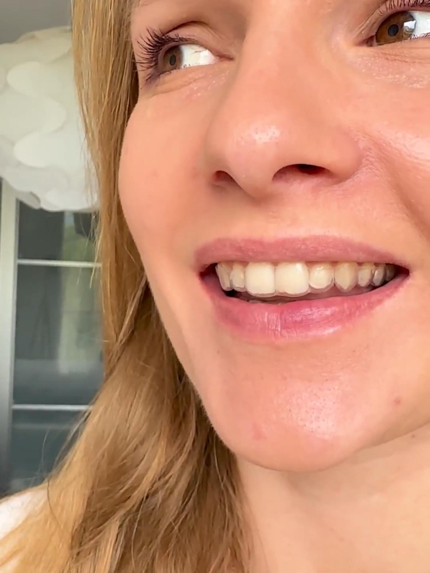 A little SmileSet ASMR :) #aligners #teethalignment #smilejo